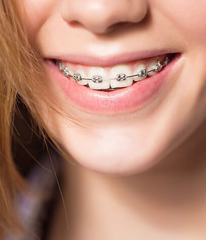 Braces