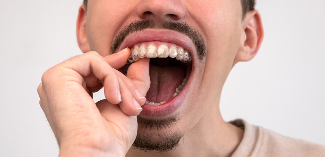 Is Wearing a Retainer Important After Getting Braces?